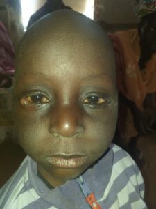 Child with trachoma Child with trachoma